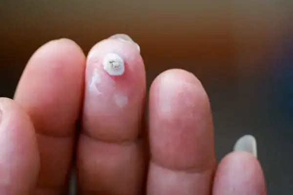 Image of white wart before cryopen treatment Brentford