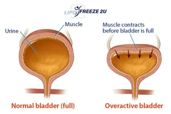 diagram of overactive bladder treatment Brentford