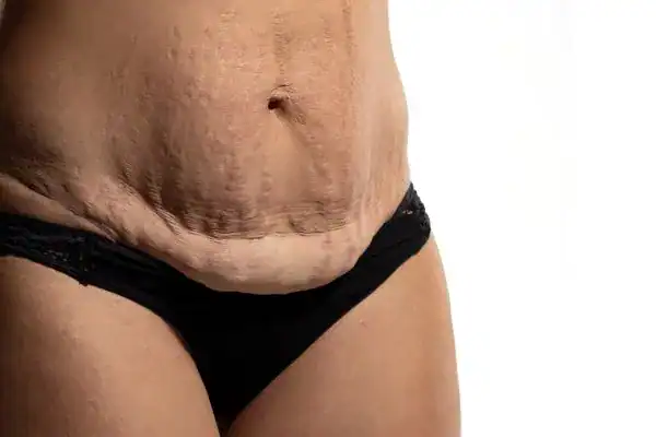 loose skin after weight loss injections Brentford