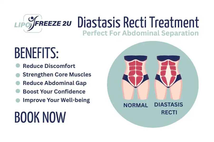 Benefits of body toning treatment Brentford for Diastasis recti