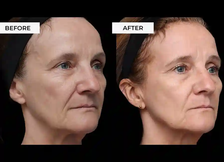 How Many RF Microneedling Sessions Will You Need to See a Difference Brentford?
