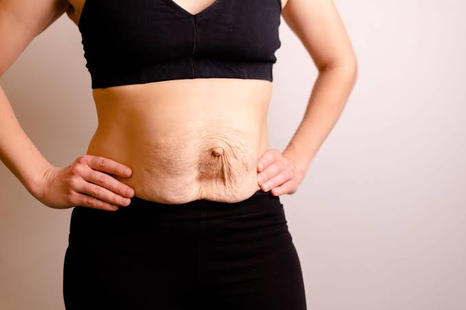 Is Surgery Really the Only Way to Repair Diastasis Recti Brentford?