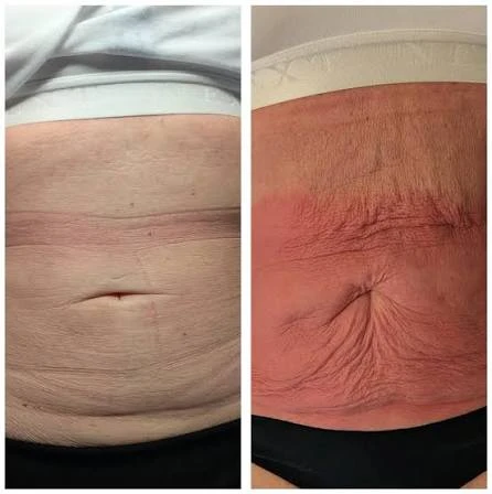 How Does RF Microneedling Improve Crepey, Thin and Uneven Skin Texture Brentford?