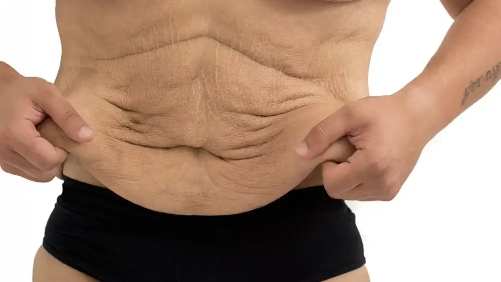 Why Does Weight Loss Medication Leave Some People With Loose or Sagging Skin Brentford?